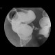 Tumorous stenosis of sigmoid colon: RF - Fluoroscopy